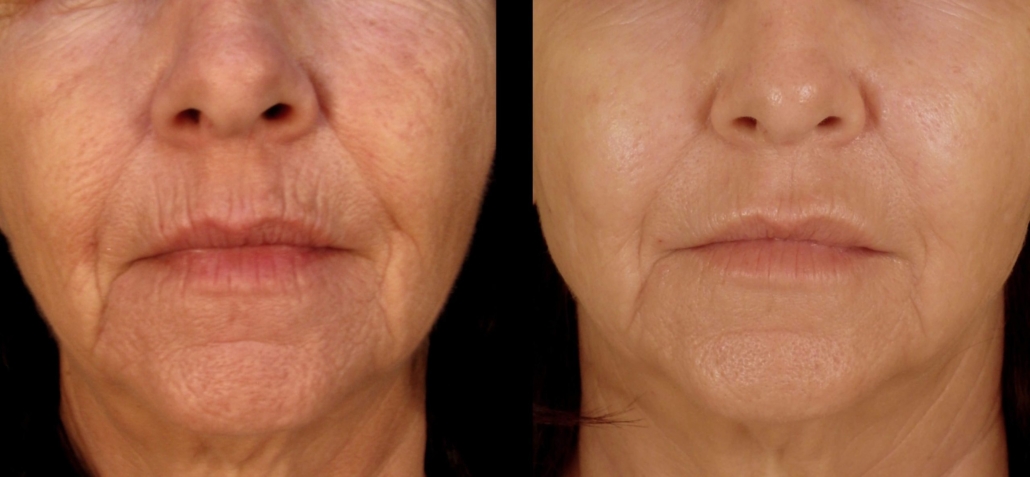 lifting-bodytite-02-scaled